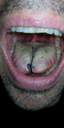 split tongue healing 2022