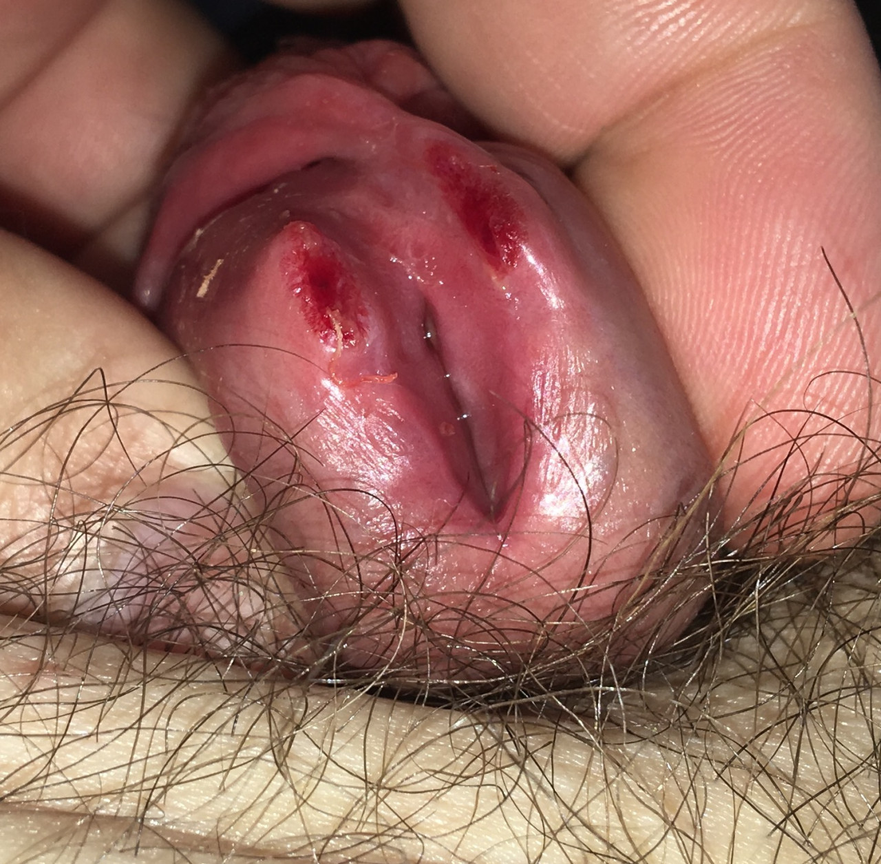 Finally opened up the PA piercing! Awesome. But not at full meato YET!