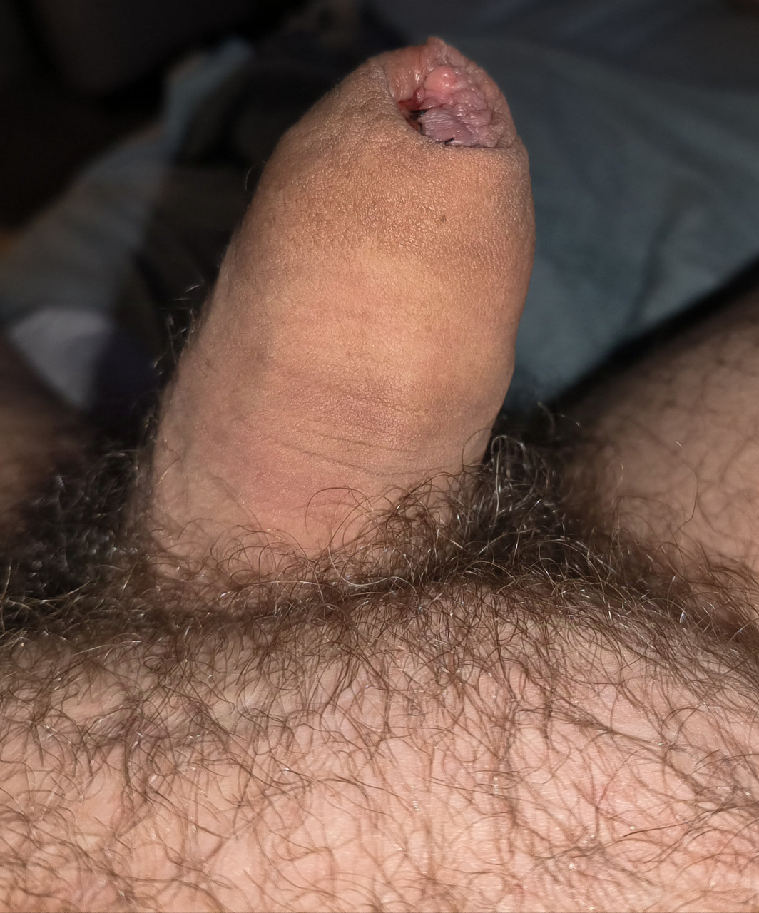 Glansectomy