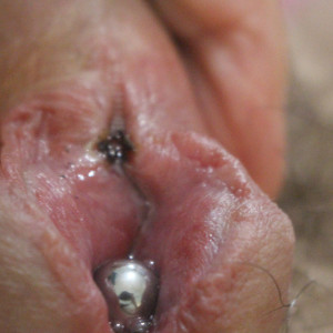 Burnt with cauterising pen