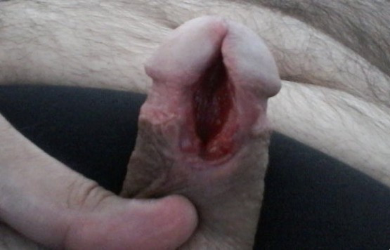 Subincision 