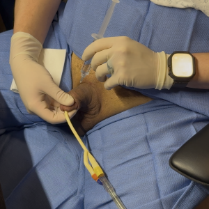 Anesthetic Injection