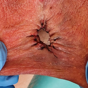 Fresh Transscrotal 
