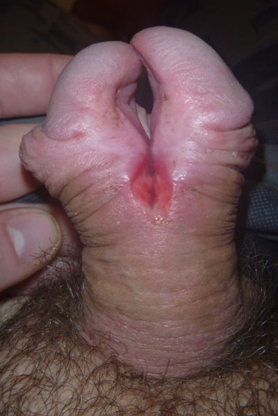 the second day after the incision