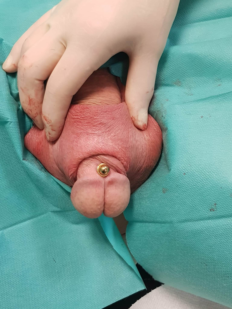 50 mm Transscrotal 