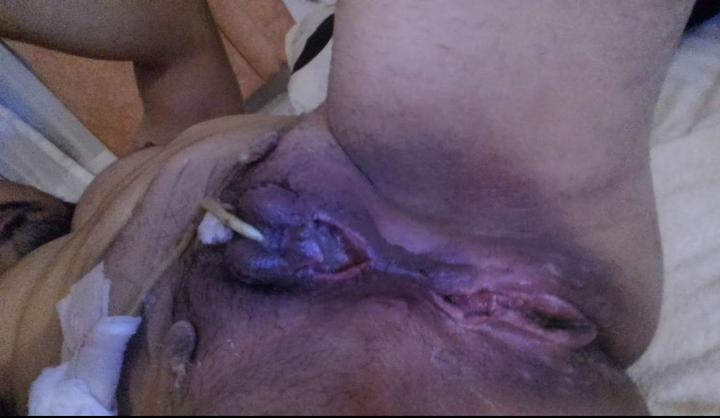 Just after surgery