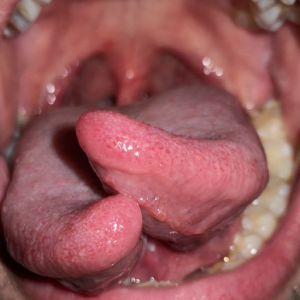 healed tongue split 2023