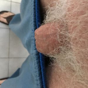 Flaccid. 10 weeks after glansectomy (and scrotectomy).