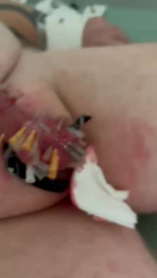 Some genital needles