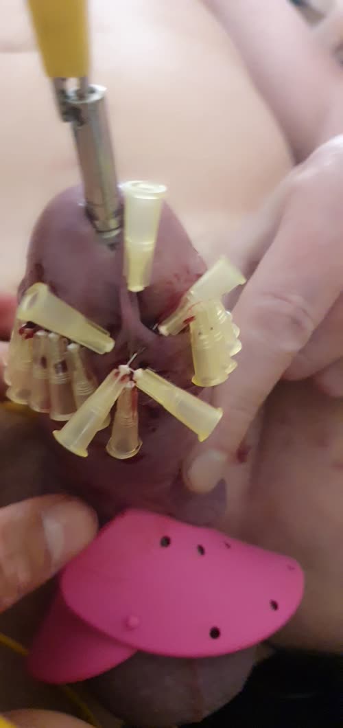 25 needles in a Belgian slave cockhead