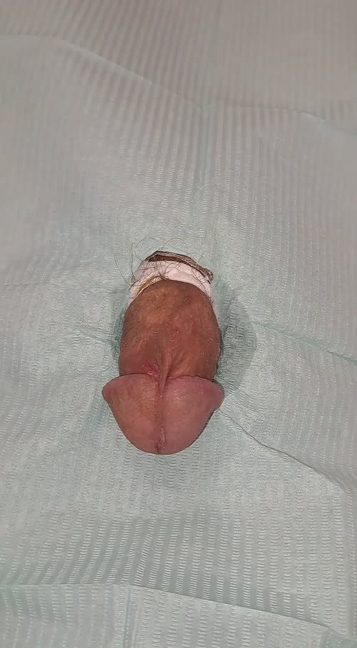 16G needle in my penis head caused massive blood loss 